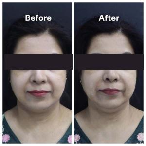 Botox result KOQ10
